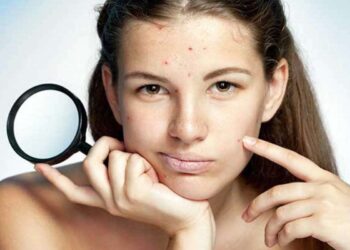 10 Ways To Get Rid of Acne