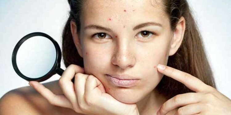 10 Ways To Get Rid of Acne