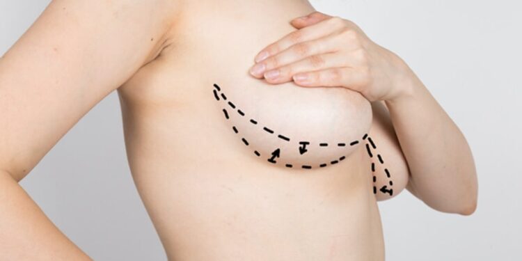 breast lift cost las vegas